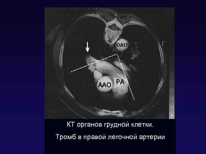 КТ органов грудной клетки. Тромб в правой легочной артерии 