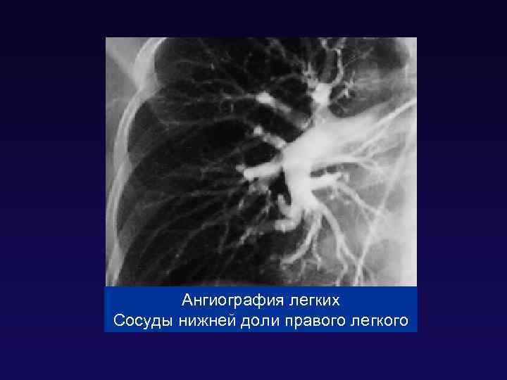 Ангиография легких Сосуды нижней доли правого легкого 