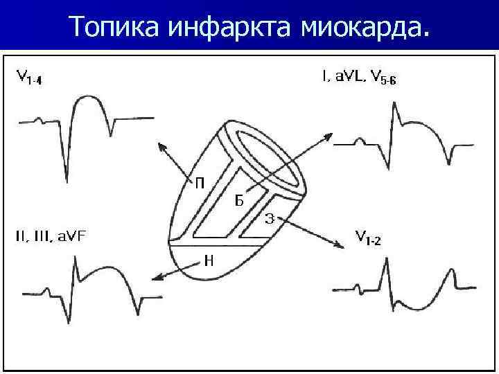 Топика инфаркта миокарда. 