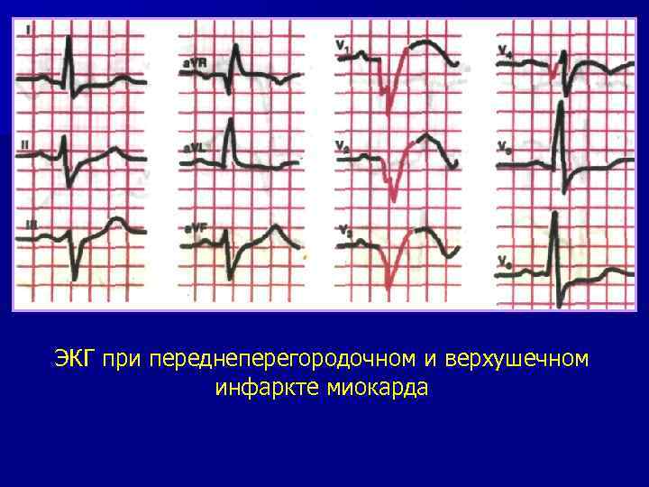 ЭКГ при переднеперегородочном и верхушечном инфаркте миокарда 