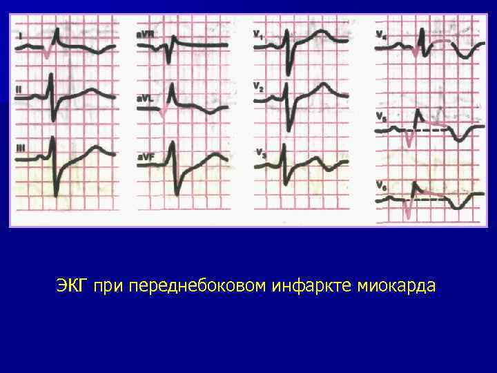 ЭКГ при переднебоковом инфаркте миокарда 
