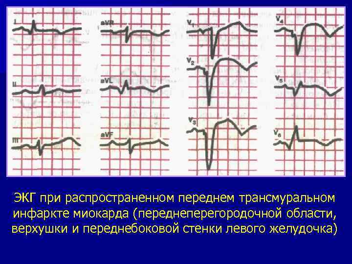 Трансмуральный инфаркт миокарда