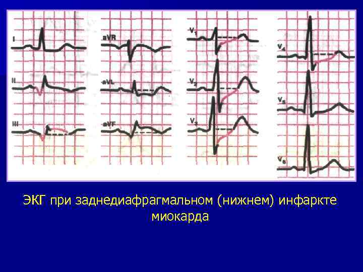 ЭКГ при заднедиафрагмальном (нижнем) инфаркте миокарда 