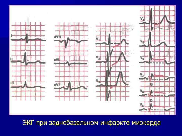ЭКГ при заднебазальном инфаркте миокарда 