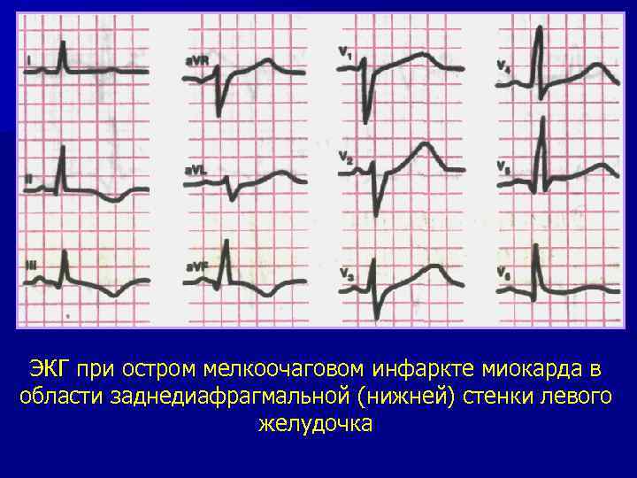 Экг диагностика