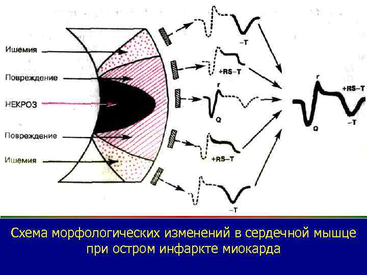 Схема морфологических изменений в сердечной мышце при остром инфаркте миокарда 