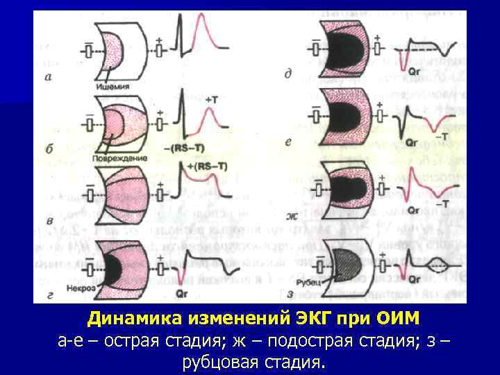Динамика изменений ЭКГ при ОИМ а-е – острая стадия; ж – подострая стадия; з