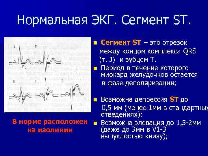 Сегмент st на экг