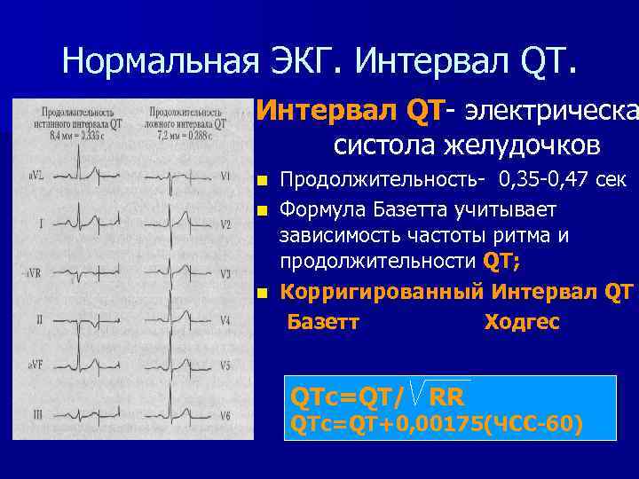 Норма экг фото во всех отведениях