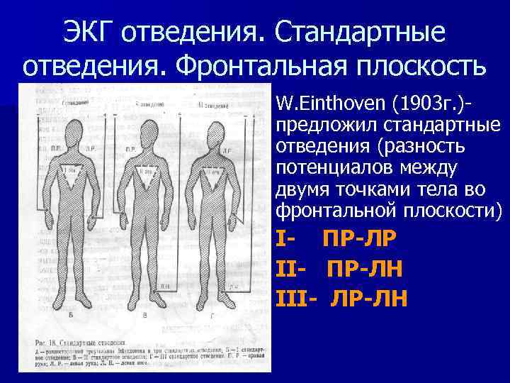ЭКГ отведения. Стандартные отведения. Фронтальная плоскость n W. Einthoven (1903 г. )предложил стандартные отведения