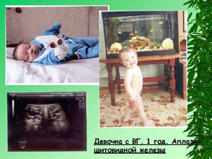 Девочка с ВГ, 1 год. Аплазия щитовидной железы 