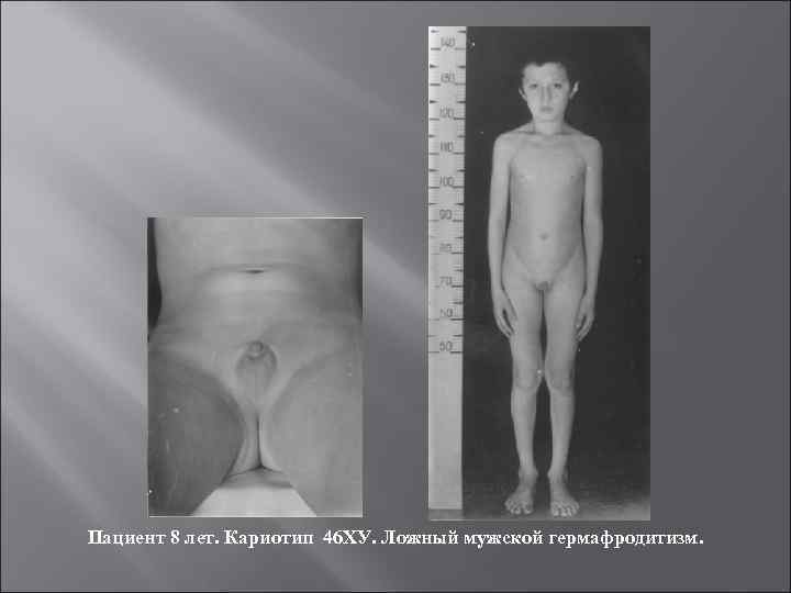 Пациент 8 лет. Кариотип 46 ХУ. Ложный мужской гермафродитизм. 