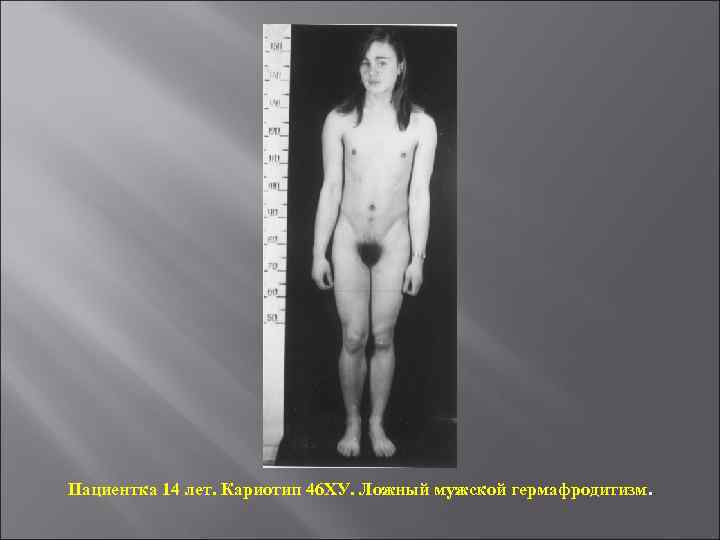 Пациентка 14 лет. Кариотип 46 ХУ. Ложный мужской гермафродитизм. 