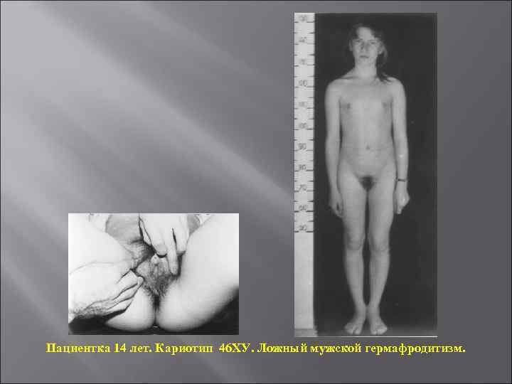 Пациентка 14 лет. Кариотип 46 ХУ. Ложный мужской гермафродитизм. 