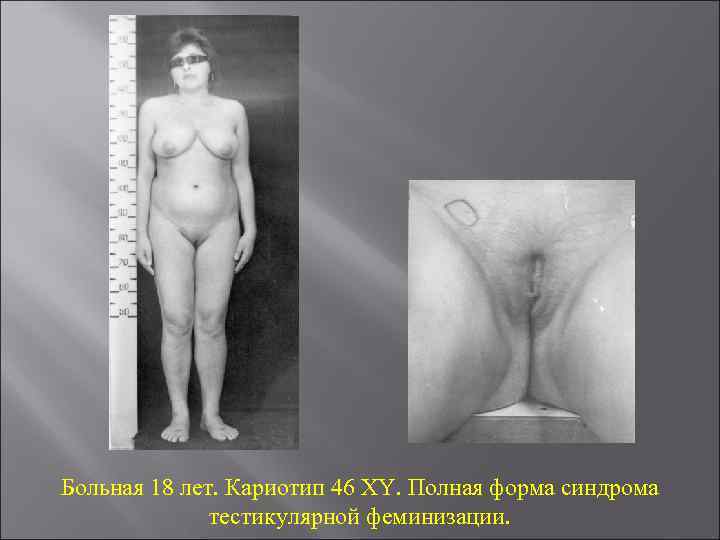 Больная 18 лет. Кариотип 46 XY. Полная форма синдрома тестикулярной феминизации. 