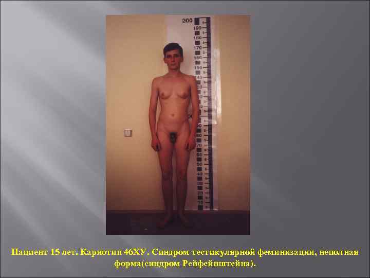 Пациент 15 лет. Кариотип 46 ХУ. Синдром тестикулярной феминизации, неполная форма(синдром Рейфейнштейна). 