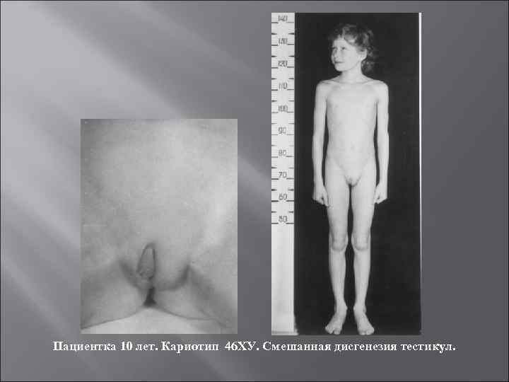 Пациентка 10 лет. Кариотип 46 ХУ. Смешанная дисгенезия тестикул. 