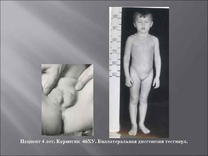 Пациент 4 лет. Кариотип 46 ХУ. Биллатеральная дисгенезия тестикул. 