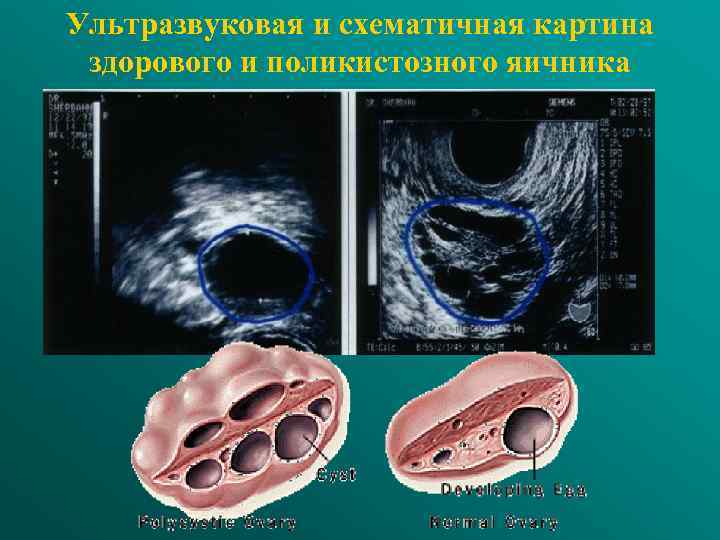 Ультразвуковая и схематичная картина здорового и поликистозного яичника 