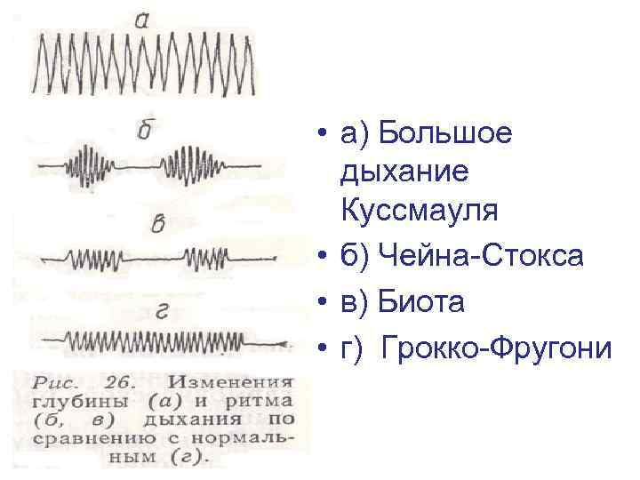  • а) Большое дыхание Куссмауля • б) Чейна-Стокса • в) Биота • г)