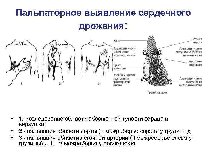 Пальпаторное выявление сердечного дрожания: • 1. -исследование области абсолютной тупости сердца и верхушки; •