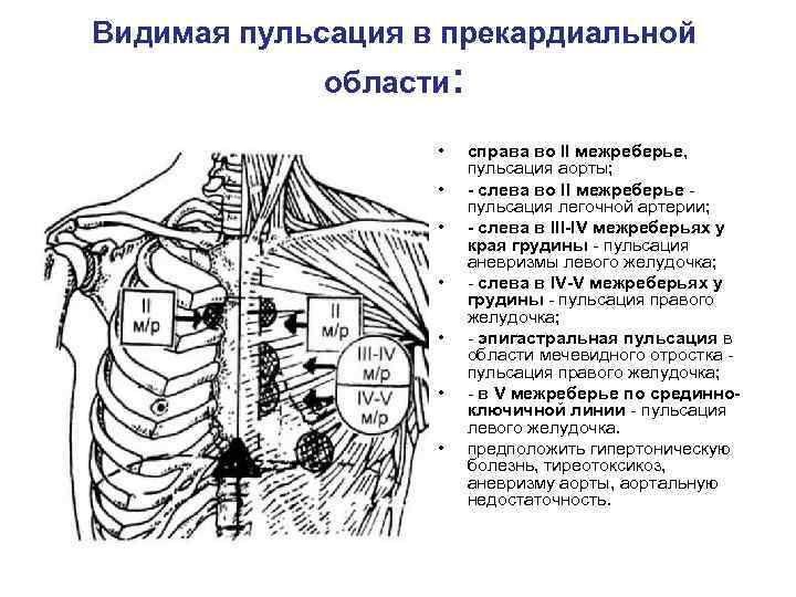 Видимая пульсация в прекардиальной области: • • справа во II межреберье, пульсация аорты; -