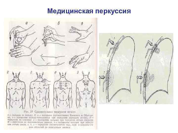 Медицинская перкуссия 