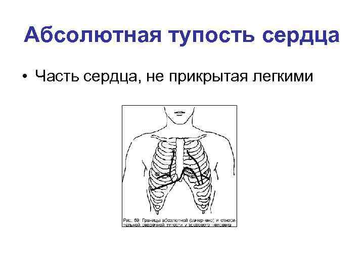 Абсолютная тупость сердца • Часть сердца, не прикрытая легкими 