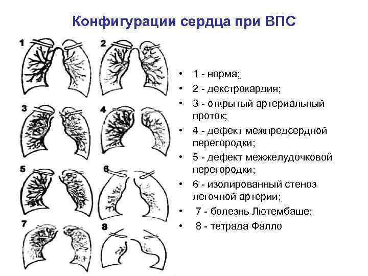 Конфигурации сердца при ВПС • 1 - норма; • 2 - декстрокардия; • 3