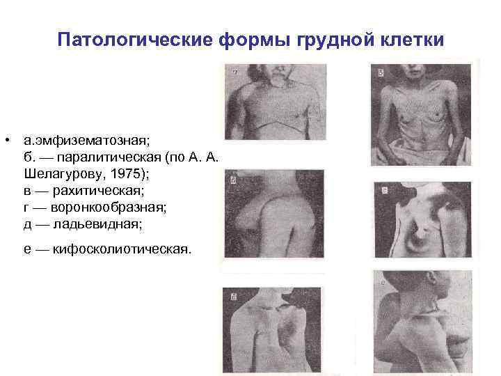 Патологические формы грудной клетки • а. эмфизематозная; б. — паралитическая (по А. А. Шелагурову,