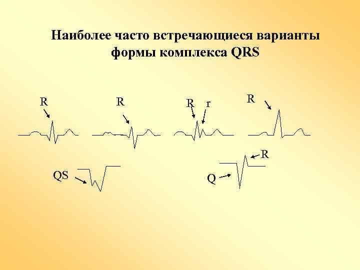 Наиболее часто встречающиеся варианты формы комплекса QRS R R R r R R QS