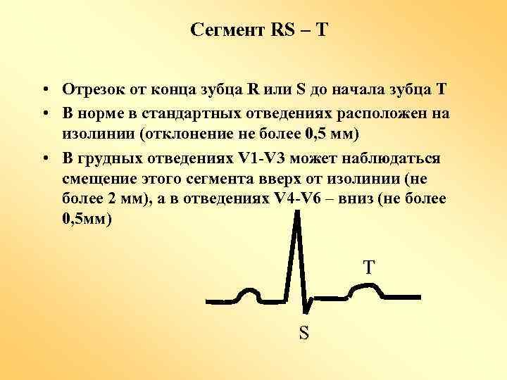 Сегмент RS – T • Отрезок от конца зубца R или S до начала