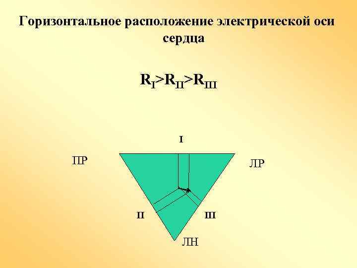 Горизонтальное расположение электрической оси сердца RI>RIII I ПР ЛР II III ЛН 