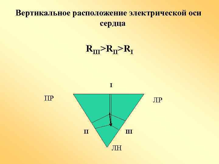 Вертикальное расположение электрической оси сердца RIII>RI I ПР ЛР II III ЛН 