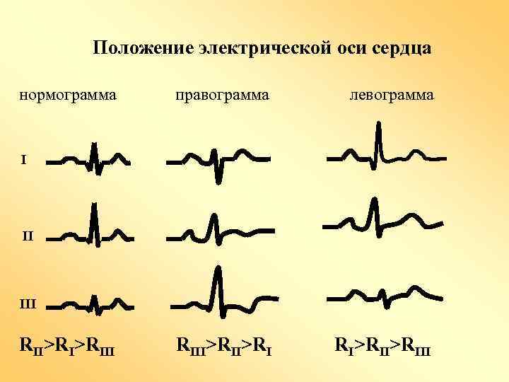 Положение электрической оси сердца нормограмма правограмма левограмма RIII>RI RI>RIII III RII>RI>RIII 