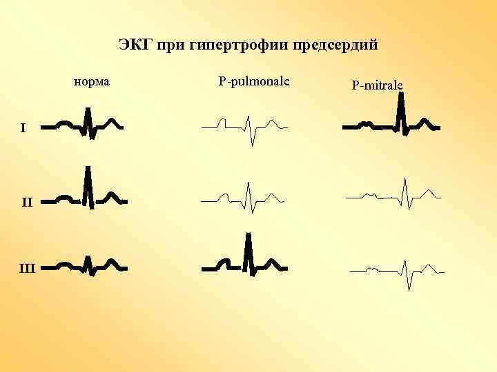 ЭКГ при гипертрофии предсердий норма I II III Р-pulmonale P-mitrale 