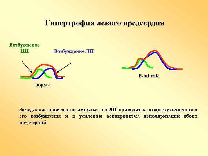 Гипертрофия левого предсердия Возбуждение ПП Возбуждение ЛП P-mitrale норма Замедление проведения импульса по ЛП