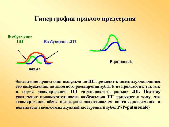 Гипертрофия правого предсердия Возбуждение ПП Возбуждение ЛП P-pulmonale норма Замедление проведения импульса по ПП