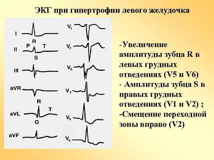 ЭКГ при гипертрофии левого желудочка -Увеличение амплитуды зубца R в левых грудных отведениях (V