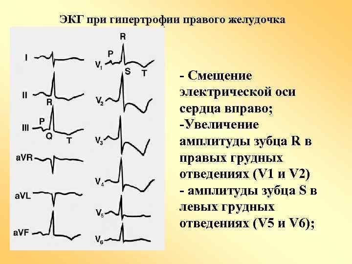 ЭКГ при гипертрофии правого желудочка - Смещение электрической оси сердца вправо; -Увеличение амплитуды зубца