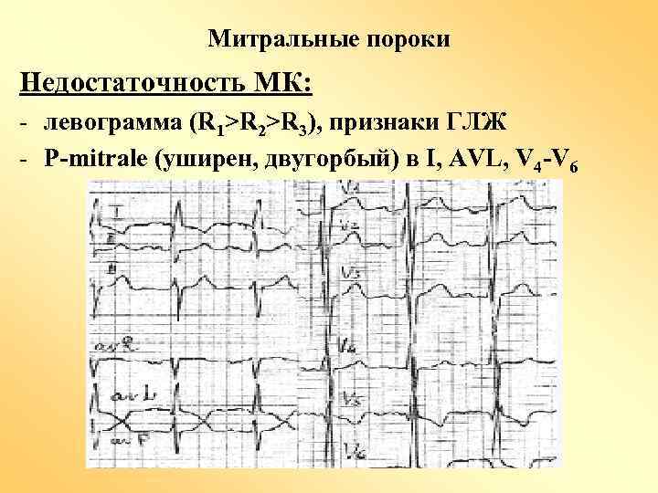 Митральные пороки Недостаточность МК: - левограмма (R 1>R 2>R 3), признаки ГЛЖ - P-mitrale