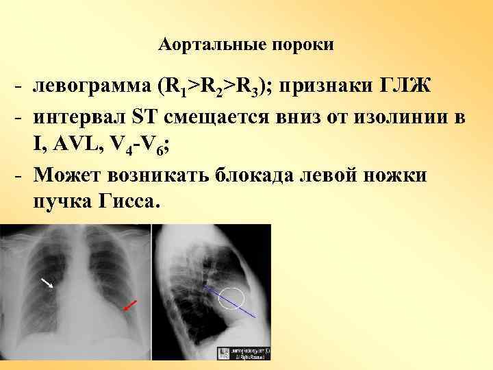 Аортальные пороки - левограмма (R 1>R 2>R 3); признаки ГЛЖ - интервал ST смещается