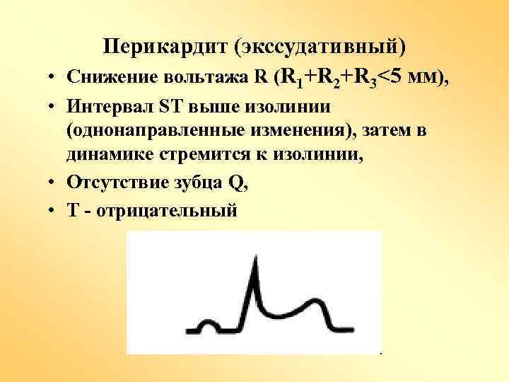 Перикардит (экссудативный) • Снижение вольтажа R (R 1+R 2+R 3<5 мм), • Интервал ST