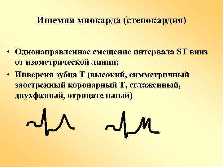 Ишемия миокарда (стенокардия) • Однонаправленное смещение интервала ST вниз от изометрической линии; • Инверсия