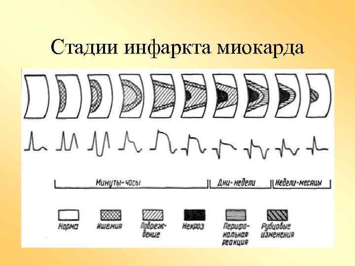 Стадии инфаркта миокарда 