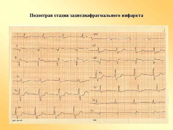 Подострая стадия заднедиафрагмального инфаркта 