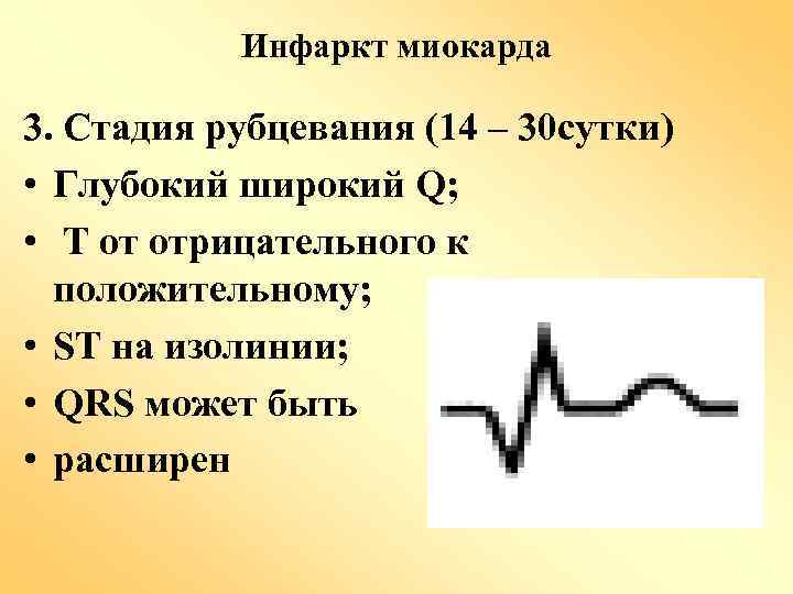 Инфаркт миокарда 3. Стадия рубцевания (14 – 30 сутки) • Глубокий широкий Q; •