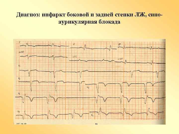 Диагноз: инфаркт боковой и задней стенки ЛЖ, синоаурикулярная блокада 