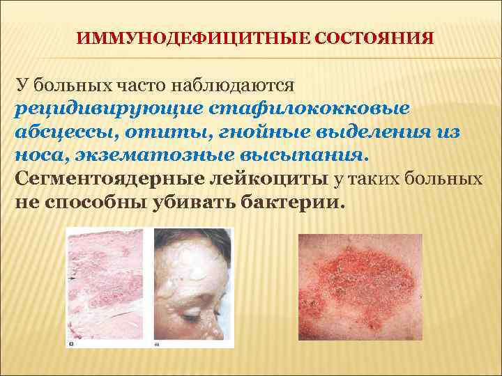 ИММУНОДЕФИЦИТНЫЕ СОСТОЯНИЯ У больных часто наблюдаются рецидивирующие стафилококковые абсцессы, отиты, гнойные выделения из носа,