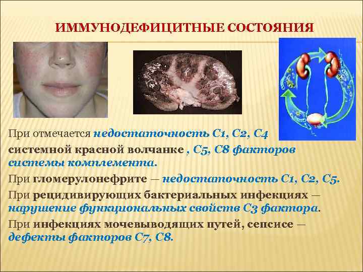 ИММУНОДЕФИЦИТНЫЕ СОСТОЯНИЯ При отмечается недостаточность С 1, С 2, С 4 системной красной волчанке